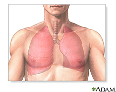 Enfermedad de obstrucción pulmonar crónica